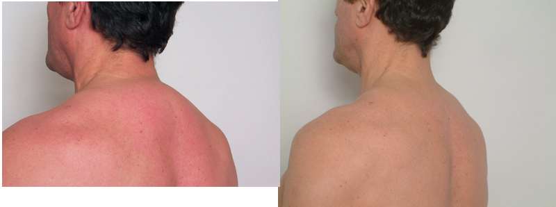 Buffalo Hump Correction Dr James Romano